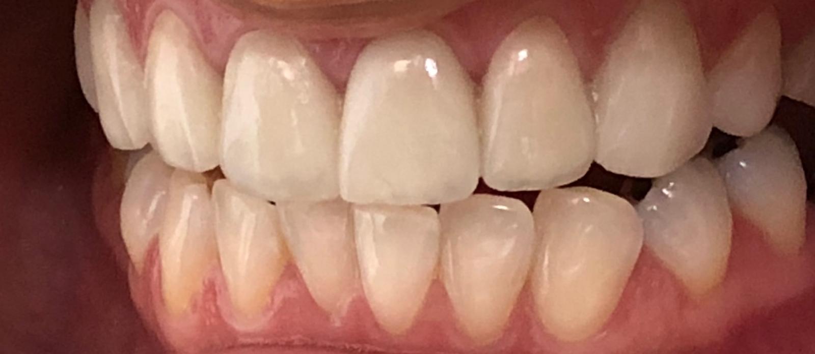 Whitening & Alignment after