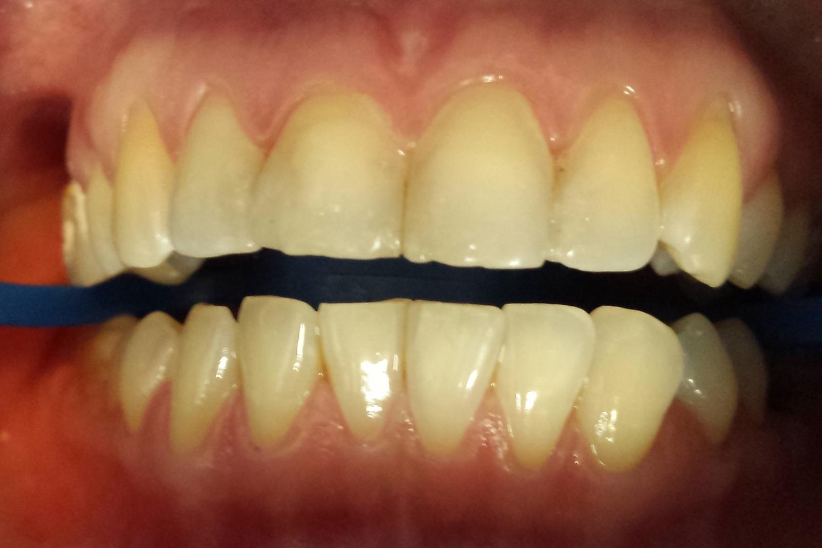 Whitening & Alignment before