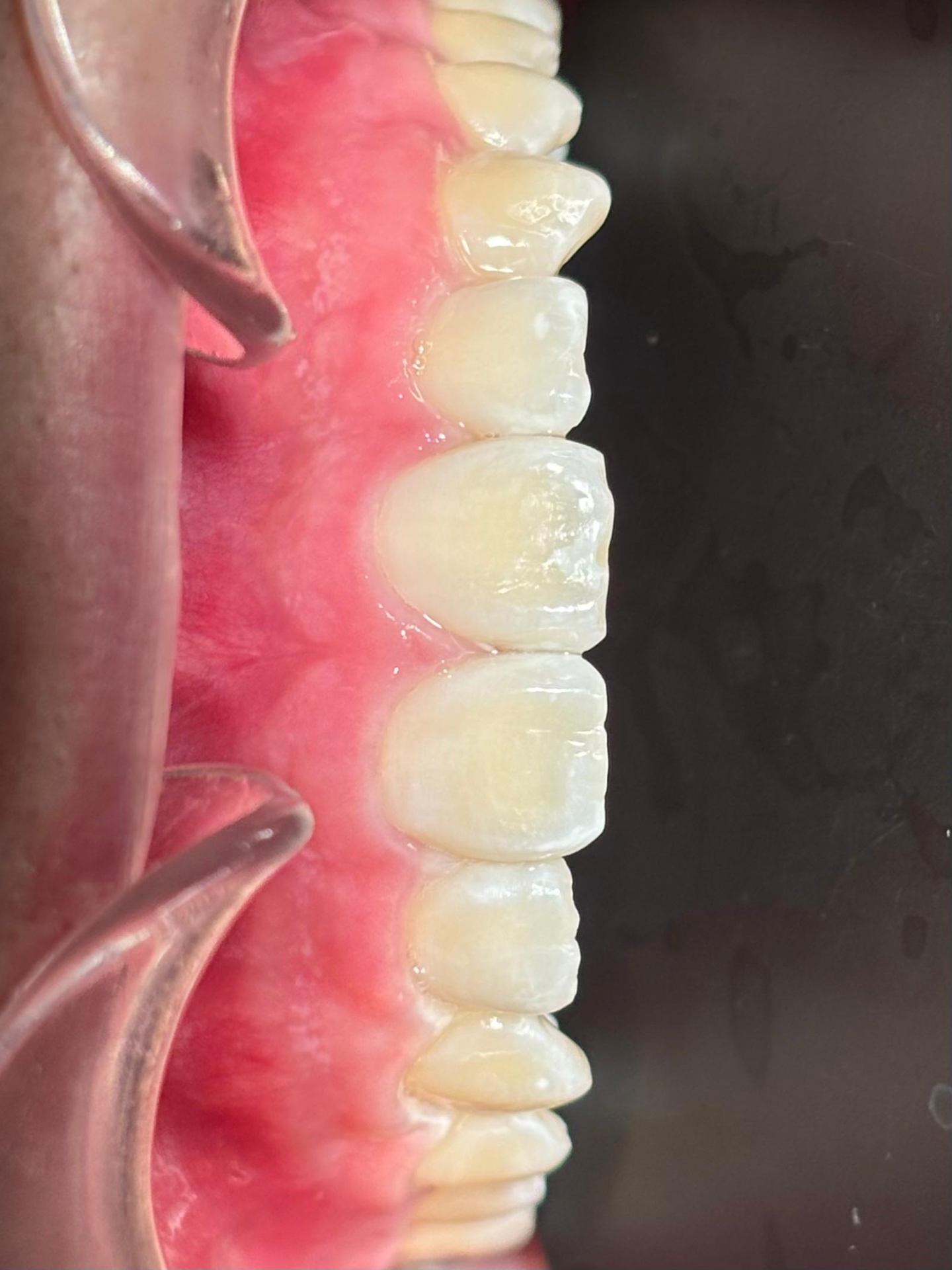 Smile Restoration after
