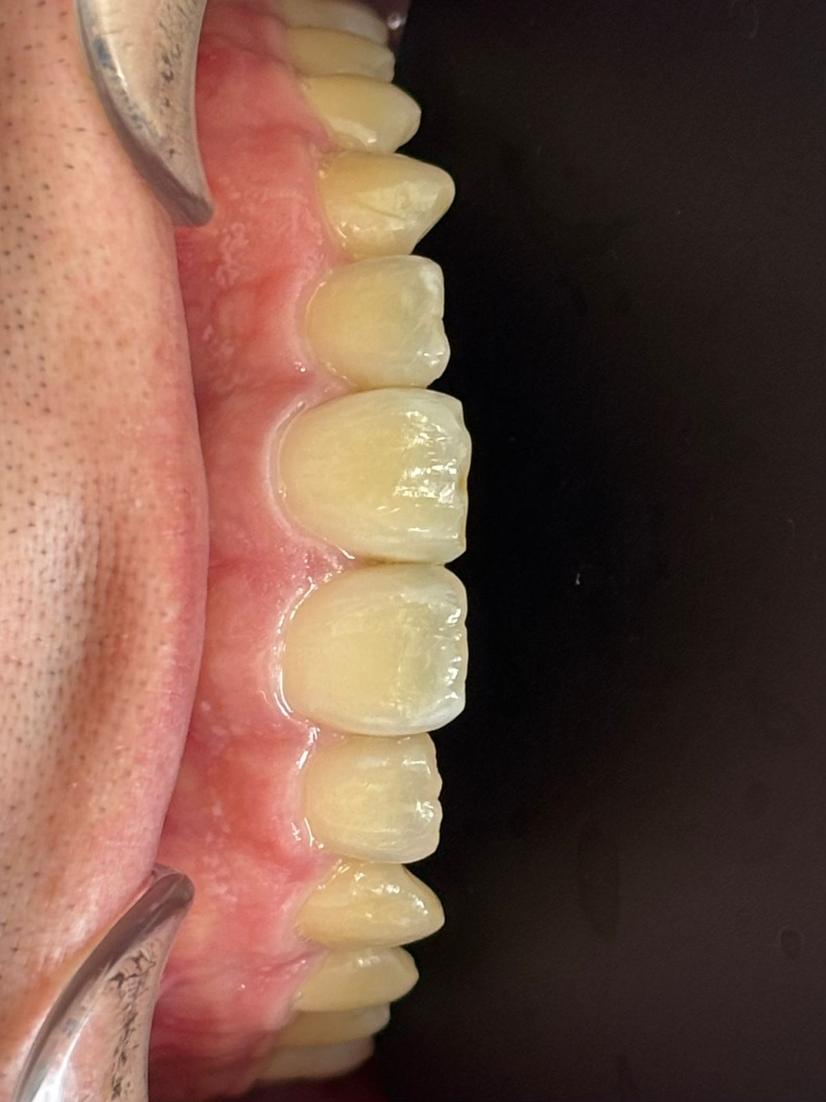 Smile Restoration before