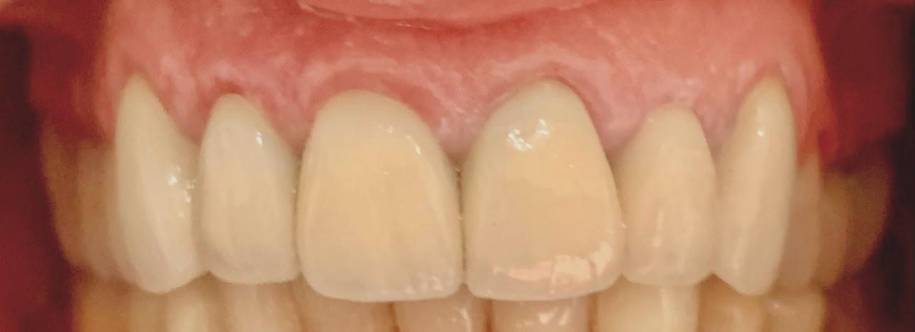 Cosmetic Veneers after