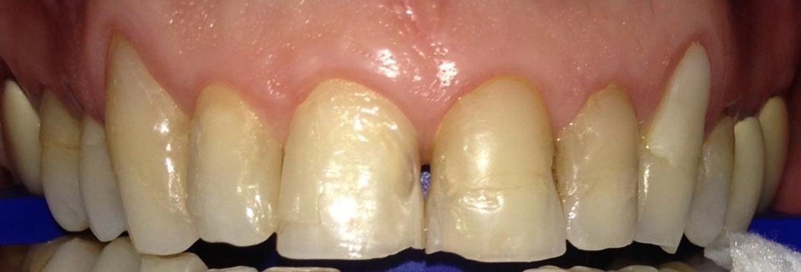 Cosmetic Veneers before